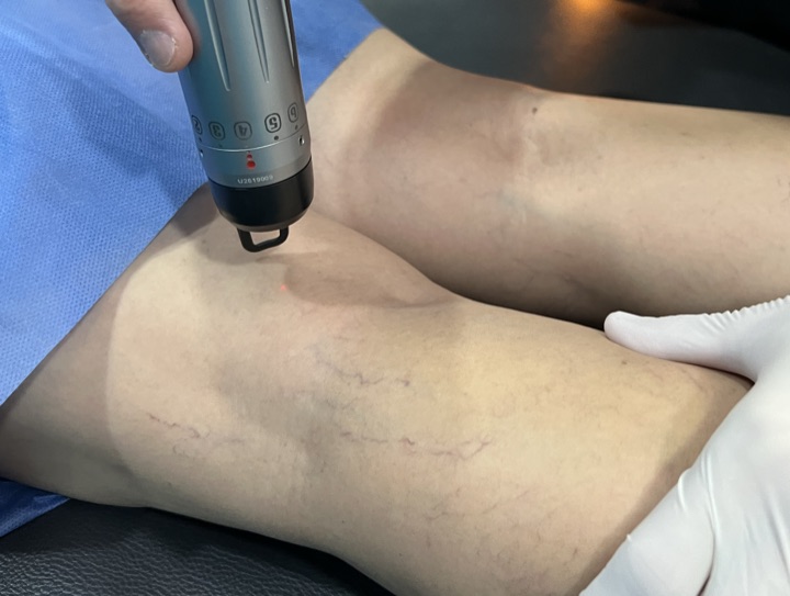 Tratamiento láser vascular de piernas en Dermaedén Villahermosa